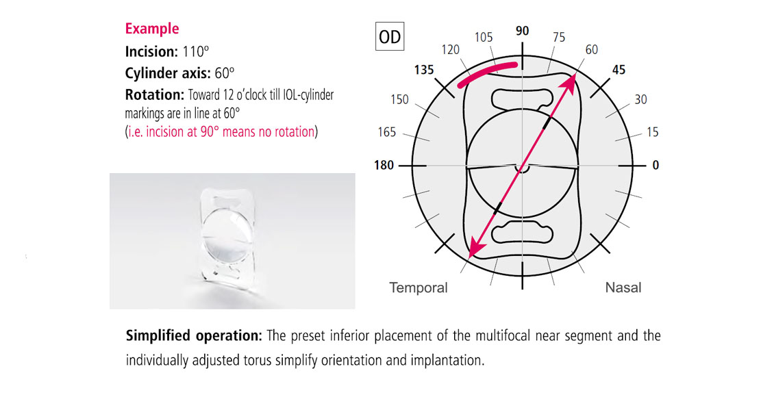 Teleon LENTIS Mplus Multifocal IOL